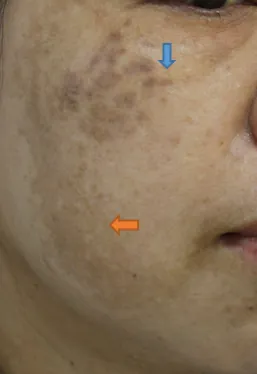 Xem Hình Ảnh Bớt Hori (nevus Hori) Và Phân Biệt Với Nám Má Cho Người Bệnh Xem Hình Ảnh Bớt Hori (nevus Hori) Và Phân Biệt Với Nám Má Cho Người Bệnh