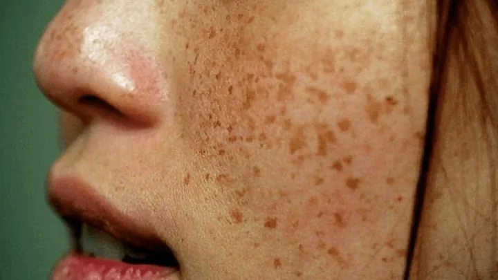 Xem Hình Ảnh Bớt Hori (nevus Hori) Và Phân Biệt Với Nám Má Cho Người Bệnh Xem Hình Ảnh Bớt Hori (nevus Hori) Và Phân Biệt Với Nám Má Cho Người Bệnh