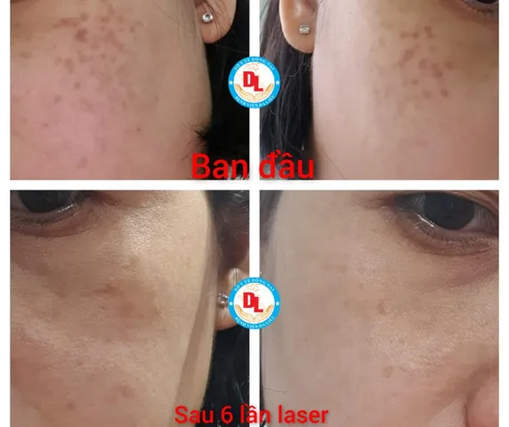 Xem Hình Ảnh Bớt Hori (nevus Hori) Và Phân Biệt Với Nám Má Cho Người Bệnh Xem Hình Ảnh Bớt Hori (nevus Hori) Và Phân Biệt Với Nám Má Cho Người Bệnh