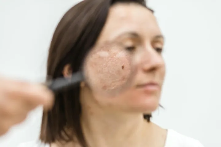 Xem Hình Ảnh Bớt Hori (nevus Hori) Và Phân Biệt Với Nám Má Cho Người Bệnh Xem Hình Ảnh Bớt Hori (nevus Hori) Và Phân Biệt Với Nám Má Cho Người Bệnh