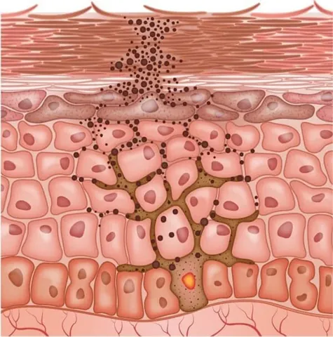 Xem Hình Ảnh Bớt Hori (nevus Hori) Và Phân Biệt Với Nám Má Cho Người Bệnh Xem Hình Ảnh Bớt Hori (nevus Hori) Và Phân Biệt Với Nám Má Cho Người Bệnh