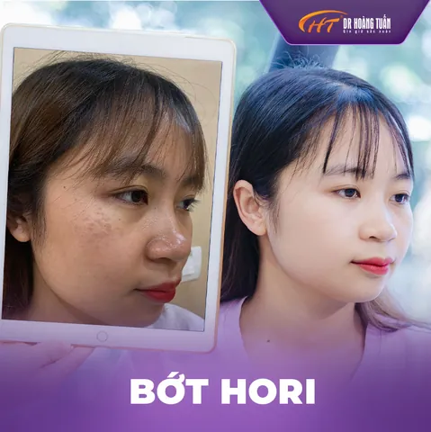 Xem Hình Ảnh Bớt Hori (nevus Hori) Và Phân Biệt Với Nám Má Cho Người Bệnh Xem Hình Ảnh Bớt Hori (nevus Hori) Và Phân Biệt Với Nám Má Cho Người Bệnh