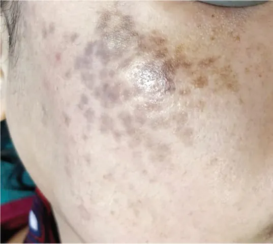 Xem Hình Ảnh Bớt Hori (nevus Hori) Và Phân Biệt Với Nám Má Cho Người Bệnh Xem Hình Ảnh Bớt Hori (nevus Hori) Và Phân Biệt Với Nám Má Cho Người Bệnh
