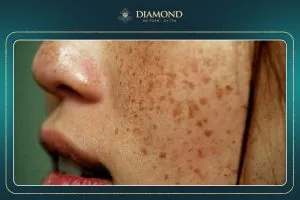 Xem Hình Ảnh Bớt Hori (nevus Hori) Và Phân Biệt Với Nám Má Cho Người Bệnh Xem Hình Ảnh Bớt Hori (nevus Hori) Và Phân Biệt Với Nám Má Cho Người Bệnh