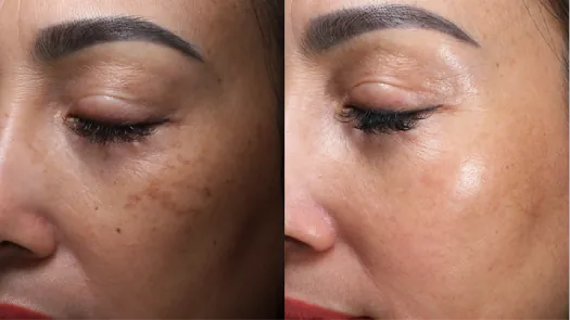 Xem Hình Ảnh Bớt Hori (nevus Hori) Và Phân Biệt Với Nám Má Cho Người Bệnh Xem Hình Ảnh Bớt Hori (nevus Hori) Và Phân Biệt Với Nám Má Cho Người Bệnh