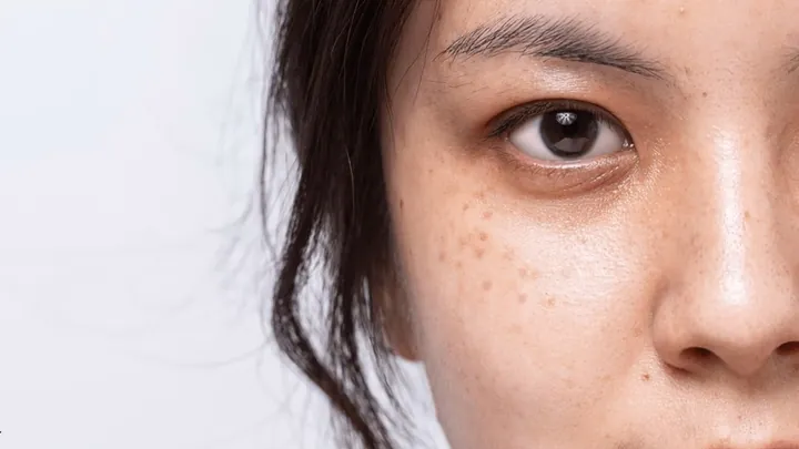 Xem Hình Ảnh Bớt Hori (nevus Hori) Và Phân Biệt Với Nám Má Cho Người Bệnh Xem Hình Ảnh Bớt Hori (nevus Hori) Và Phân Biệt Với Nám Má Cho Người Bệnh