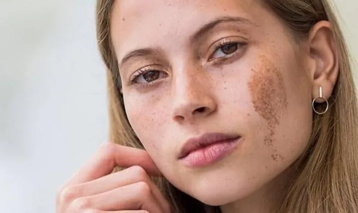 Xem Hình Ảnh Bớt Hori (nevus Hori) Và Phân Biệt Với Nám Má Cho Người Bệnh Xem Hình Ảnh Bớt Hori (nevus Hori) Và Phân Biệt Với Nám Má Cho Người Bệnh
