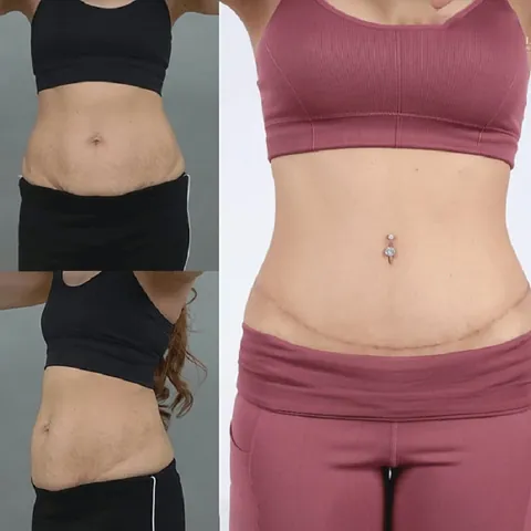 Nhận Diện Các Dạng Hình Ảnh Bụng Mỡ Ở Phái Nữ Và Phân Biệt Với Bụng Bầu Nhận Diện Các Dạng Hình Ảnh Bụng Mỡ Ở Phái Nữ Và Phân Biệt Với Bụng Bầu