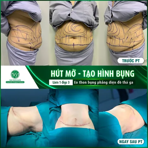 Nhận Diện Các Dạng Hình Ảnh Bụng Mỡ Ở Phái Nữ Và Phân Biệt Với Bụng Bầu Nhận Diện Các Dạng Hình Ảnh Bụng Mỡ Ở Phái Nữ Và Phân Biệt Với Bụng Bầu