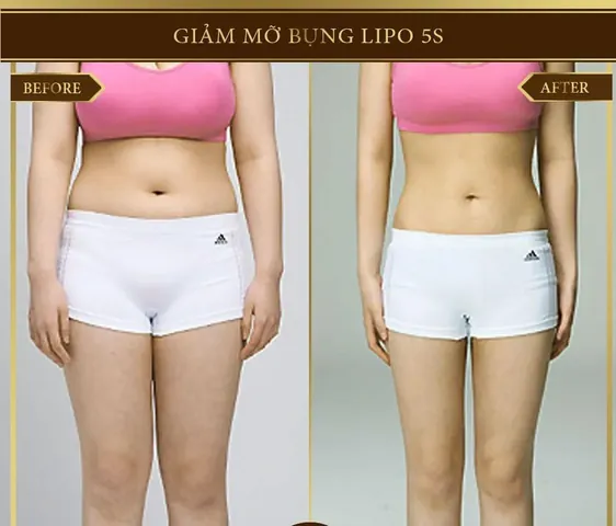 Nhận Diện Các Dạng Hình Ảnh Bụng Mỡ Ở Phái Nữ Và Phân Biệt Với Bụng Bầu Nhận Diện Các Dạng Hình Ảnh Bụng Mỡ Ở Phái Nữ Và Phân Biệt Với Bụng Bầu