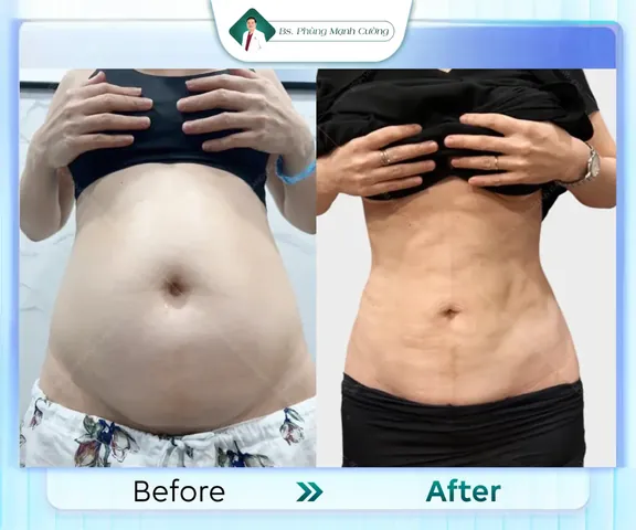 Nhận Diện Các Dạng Hình Ảnh Bụng Mỡ Ở Phái Nữ Và Phân Biệt Với Bụng Bầu Nhận Diện Các Dạng Hình Ảnh Bụng Mỡ Ở Phái Nữ Và Phân Biệt Với Bụng Bầu