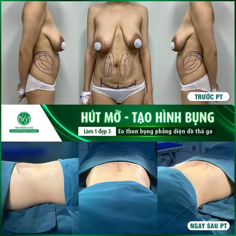 Nhận Diện Các Dạng Hình Ảnh Bụng Mỡ Ở Phái Nữ Và Phân Biệt Với Bụng Bầu Nhận Diện Các Dạng Hình Ảnh Bụng Mỡ Ở Phái Nữ Và Phân Biệt Với Bụng Bầu