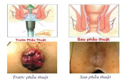 Xem Hình Ảnh Thực Tế Cắt Trĩ Trước Và Sau Phẫu Thuật Cho Người Bệnh