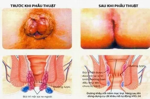 Xem Hình Ảnh Thực Tế Cắt Trĩ Trước Và Sau Phẫu Thuật Cho Người Bệnh
