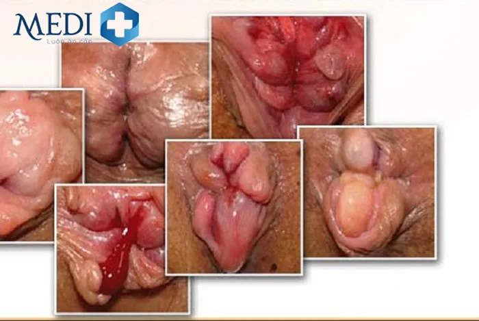 Xem Hình Ảnh Thực Tế Cắt Trĩ Trước Và Sau Phẫu Thuật Cho Người Bệnh