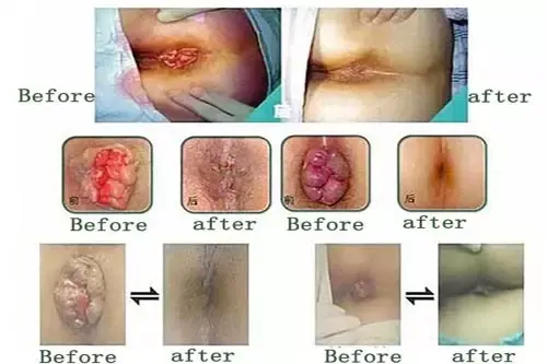 Xem Hình Ảnh Thực Tế Cắt Trĩ Trước Và Sau Phẫu Thuật Cho Người Bệnh