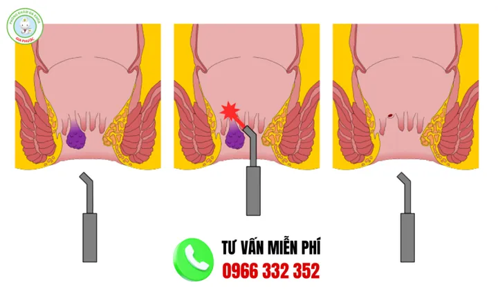 Xem Hình Ảnh Thực Tế Cắt Trĩ Trước Và Sau Phẫu Thuật Cho Người Bệnh