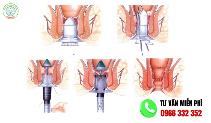 Xem Hình Ảnh Thực Tế Cắt Trĩ Trước Và Sau Phẫu Thuật Cho Người Bệnh