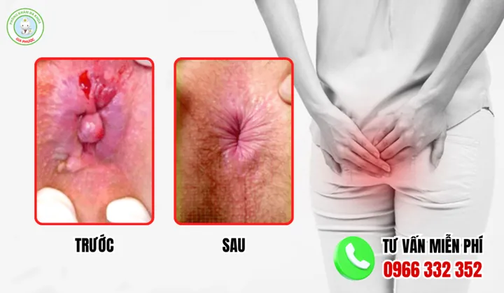 Xem Hình Ảnh Thực Tế Cắt Trĩ Trước Và Sau Phẫu Thuật Cho Người Bệnh