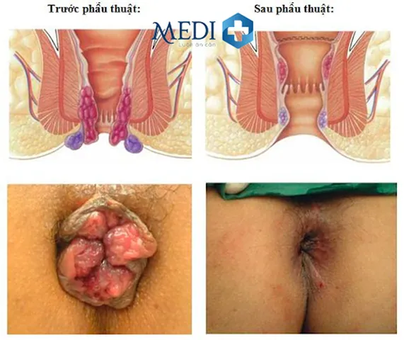 Xem Hình Ảnh Thực Tế Cắt Trĩ Trước Và Sau Phẫu Thuật Cho Người Bệnh