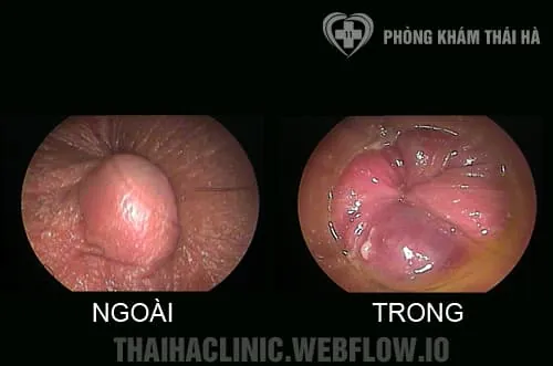 Xem Hình Ảnh Thực Tế Cắt Trĩ Trước Và Sau Phẫu Thuật Cho Người Bệnh