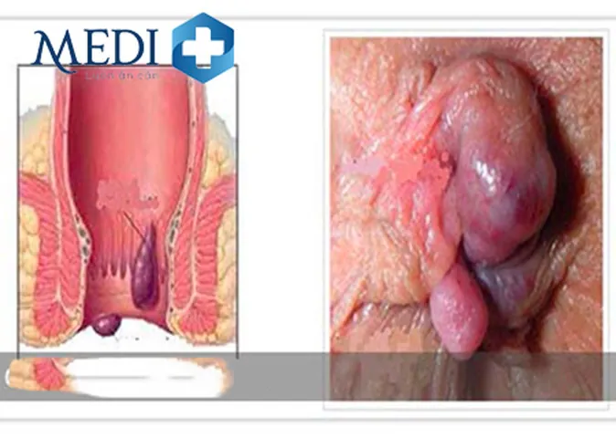 Xem Hình Ảnh Thực Tế Cắt Trĩ Trước Và Sau Phẫu Thuật Cho Người Bệnh