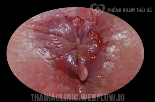 Xem Hình Ảnh Thực Tế Cắt Trĩ Trước Và Sau Phẫu Thuật Cho Người Bệnh