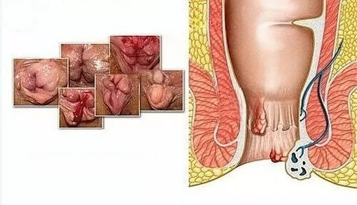 Xem Hình Ảnh Thực Tế Cắt Trĩ Trước Và Sau Phẫu Thuật Cho Người Bệnh