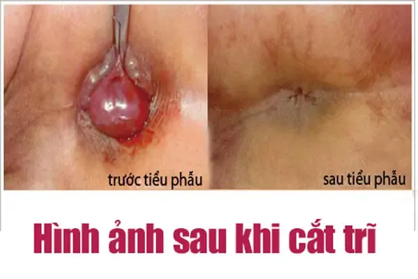 Xem Hình Ảnh Thực Tế Cắt Trĩ Trước Và Sau Phẫu Thuật Cho Người Bệnh