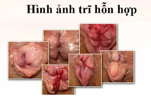 Xem Hình Ảnh Thực Tế Cắt Trĩ Trước Và Sau Phẫu Thuật Cho Người Bệnh