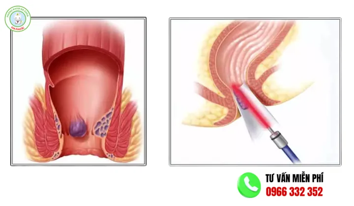 Xem Hình Ảnh Thực Tế Cắt Trĩ Trước Và Sau Phẫu Thuật Cho Người Bệnh