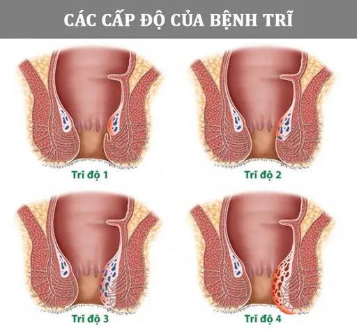 Xem Hình Ảnh Thực Tế Cắt Trĩ Trước Và Sau Phẫu Thuật Cho Người Bệnh