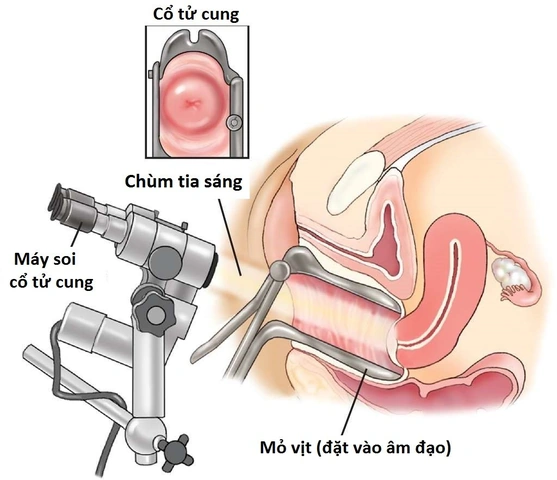 Xem Hình Ảnh Chi Tiết Sùi Mào Gà Ở Cổ Tử Cung: Hướng Dẫn Dành Cho Phụ Nữ
