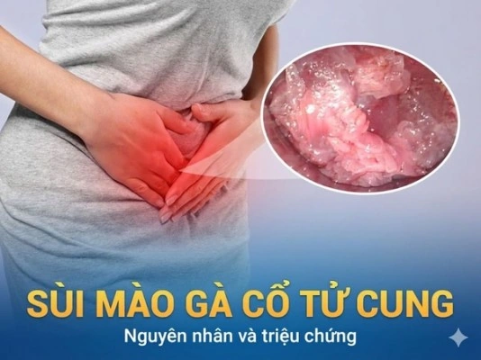 Xem Hình Ảnh Chi Tiết Sùi Mào Gà Ở Cổ Tử Cung: Hướng Dẫn Dành Cho Phụ Nữ