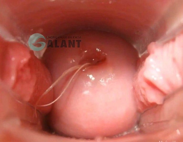 Xem Hình Ảnh Chi Tiết Sùi Mào Gà Ở Cổ Tử Cung: Hướng Dẫn Dành Cho Phụ Nữ