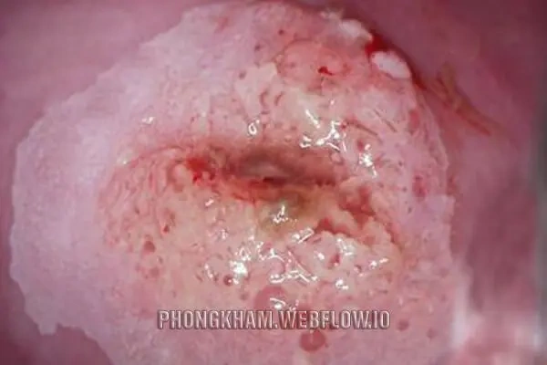 Xem Hình Ảnh Chi Tiết Sùi Mào Gà Ở Cổ Tử Cung: Hướng Dẫn Dành Cho Phụ Nữ