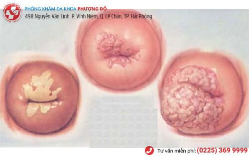 Xem Hình Ảnh Chi Tiết Sùi Mào Gà Ở Cổ Tử Cung: Hướng Dẫn Dành Cho Phụ Nữ