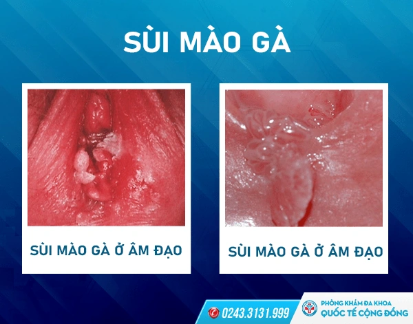 Xem Hình Ảnh Chi Tiết Sùi Mào Gà Ở Cổ Tử Cung: Hướng Dẫn Dành Cho Phụ Nữ