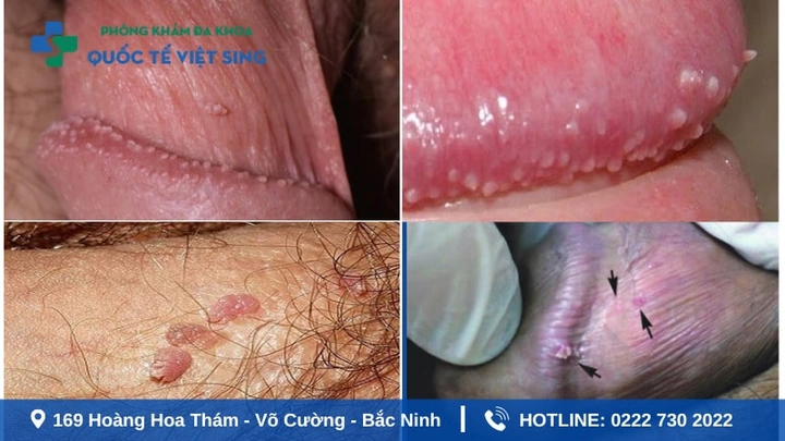 Xem Hình Ảnh Chi Tiết Sùi Mào Gà Ở Cổ Tử Cung: Hướng Dẫn Dành Cho Phụ Nữ