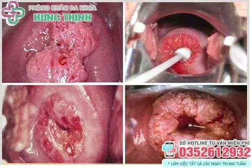 Xem Hình Ảnh Chi Tiết Sùi Mào Gà Ở Cổ Tử Cung: Hướng Dẫn Dành Cho Phụ Nữ
