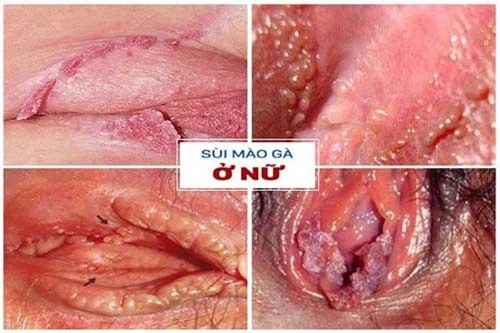 Xem Hình Ảnh Chi Tiết Sùi Mào Gà Ở Cổ Tử Cung: Hướng Dẫn Dành Cho Phụ Nữ