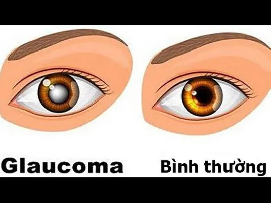 Xem Hình Ảnh Và Dấu Hiệu Nhận Biết Cườm Mắt Cho Người Bệnh: Phân Biệt Cườm Khô Và Cườm Nước Xem Hình Ảnh Và Dấu Hiệu Nhận Biết Cườm Mắt Cho Người Bệnh: Phân Biệt Cườm Khô Và Cườm Nước