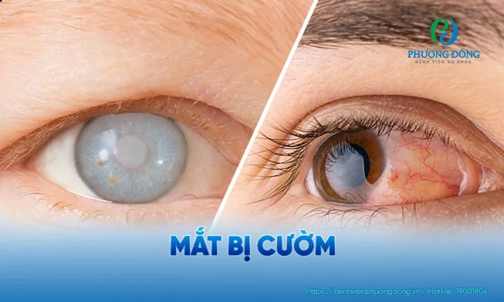 Xem Hình Ảnh Và Dấu Hiệu Nhận Biết Cườm Mắt Cho Người Bệnh: Phân Biệt Cườm Khô Và Cườm Nước Xem Hình Ảnh Và Dấu Hiệu Nhận Biết Cườm Mắt Cho Người Bệnh: Phân Biệt Cườm Khô Và Cườm Nước