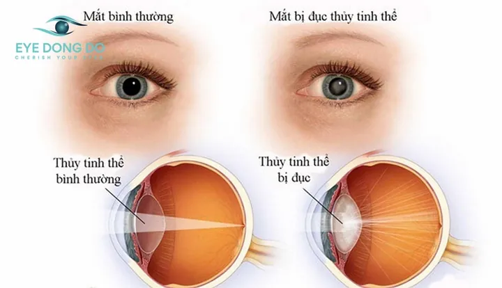 Xem Hình Ảnh Và Dấu Hiệu Nhận Biết Cườm Mắt Cho Người Bệnh: Phân Biệt Cườm Khô Và Cườm Nước Xem Hình Ảnh Và Dấu Hiệu Nhận Biết Cườm Mắt Cho Người Bệnh: Phân Biệt Cườm Khô Và Cườm Nước