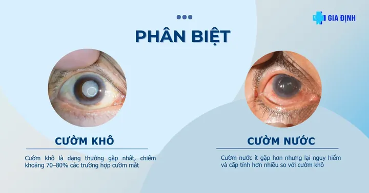 Xem Hình Ảnh Và Dấu Hiệu Nhận Biết Cườm Mắt Cho Người Bệnh: Phân Biệt Cườm Khô Và Cườm Nước Xem Hình Ảnh Và Dấu Hiệu Nhận Biết Cườm Mắt Cho Người Bệnh: Phân Biệt Cườm Khô Và Cườm Nước