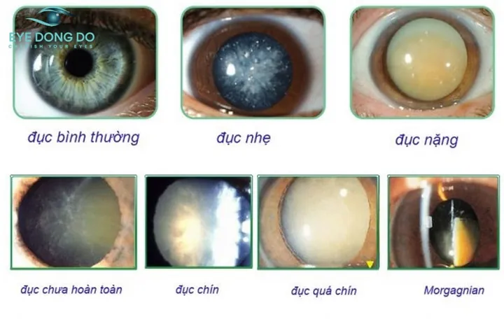 Xem Hình Ảnh Và Dấu Hiệu Nhận Biết Cườm Mắt Cho Người Bệnh: Phân Biệt Cườm Khô Và Cườm Nước Xem Hình Ảnh Và Dấu Hiệu Nhận Biết Cườm Mắt Cho Người Bệnh: Phân Biệt Cườm Khô Và Cườm Nước