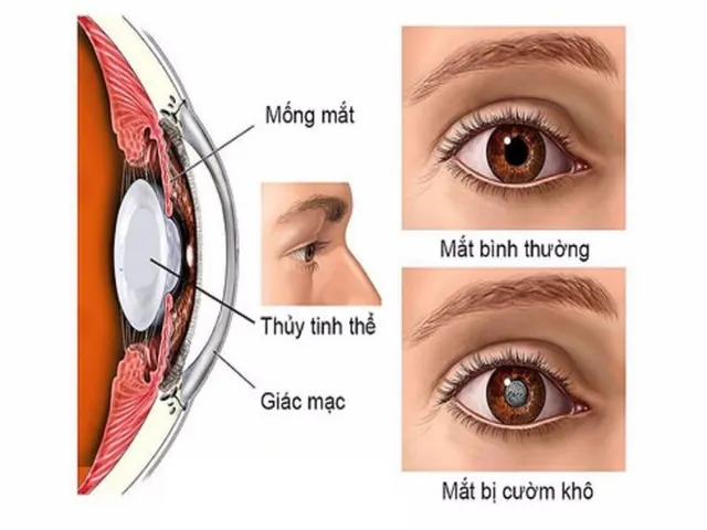 Xem Hình Ảnh Và Dấu Hiệu Nhận Biết Cườm Mắt Cho Người Bệnh: Phân Biệt Cườm Khô Và Cườm Nước Xem Hình Ảnh Và Dấu Hiệu Nhận Biết Cườm Mắt Cho Người Bệnh: Phân Biệt Cườm Khô Và Cườm Nước