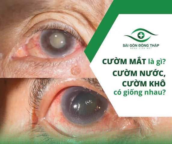Xem Hình Ảnh Và Dấu Hiệu Nhận Biết Cườm Mắt Cho Người Bệnh: Phân Biệt Cườm Khô Và Cườm Nước Xem Hình Ảnh Và Dấu Hiệu Nhận Biết Cườm Mắt Cho Người Bệnh: Phân Biệt Cườm Khô Và Cườm Nước