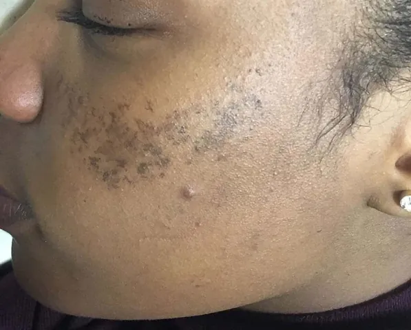 Nhận Diện Hình Ảnh Da Nám Thực Tế Để Phân Biệt Các Loại (nám Mảng, Chân Sâu, Đốm) Cho Chị Em