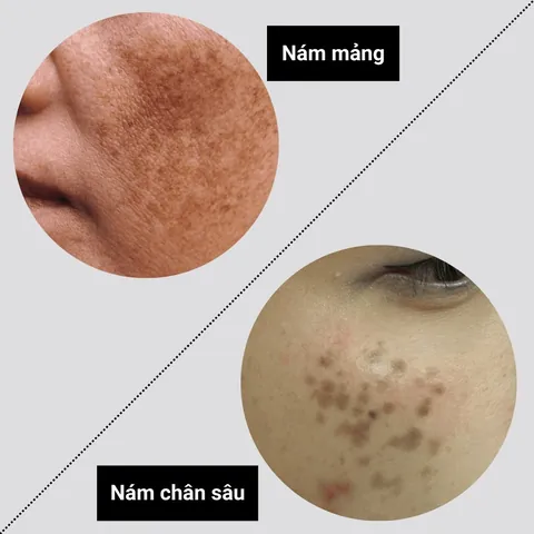 Nhận Diện Hình Ảnh Da Nám Thực Tế Để Phân Biệt Các Loại (nám Mảng, Chân Sâu, Đốm) Cho Chị Em